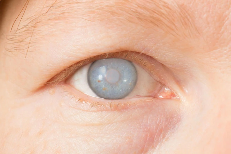 Поширені проблеми та захворювання очей, способи їх запобігання та лікування - фото №3